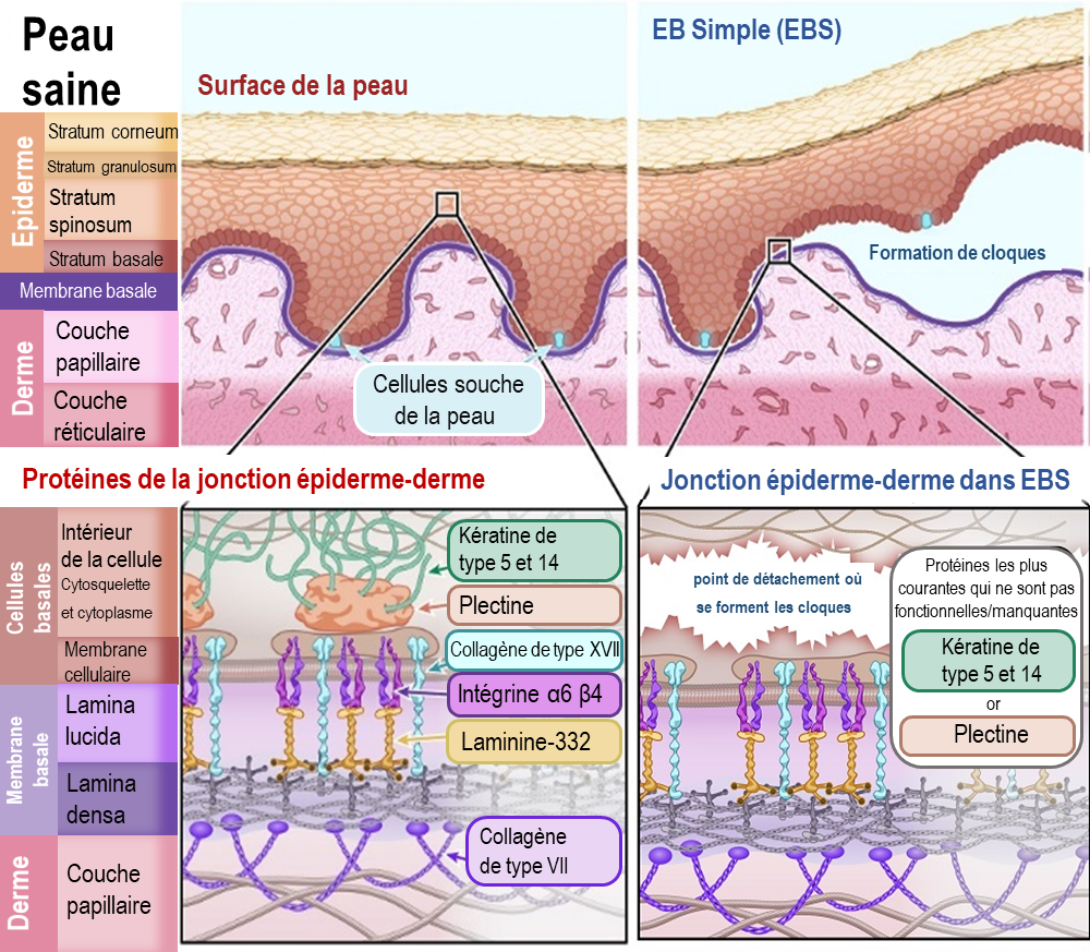 Épidermolyse bulleuse: comment la thérapie génique et cellulaire peut ...